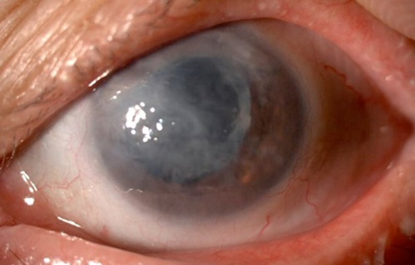 <p>Information for Condition:</p><p>Corneal decomposition following cataract surgery of lens</p>