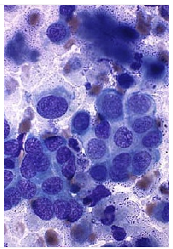 <ul><li><p>Epithelial tumors (usually end with the carcinoma) </p></li></ul><p></p>
