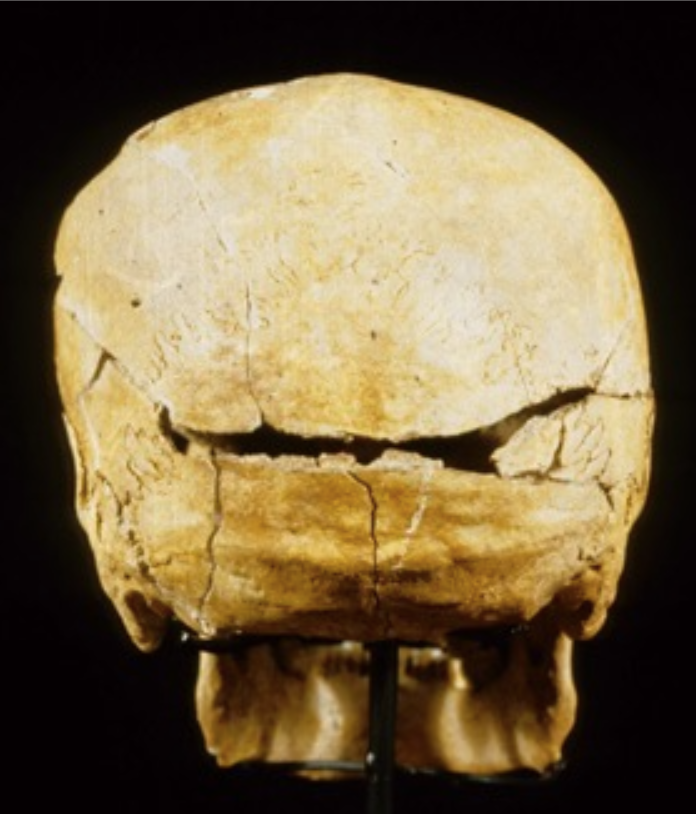 <p><span>What type of trauma caused this injury and what type of fracture is exhibited?</span></p>