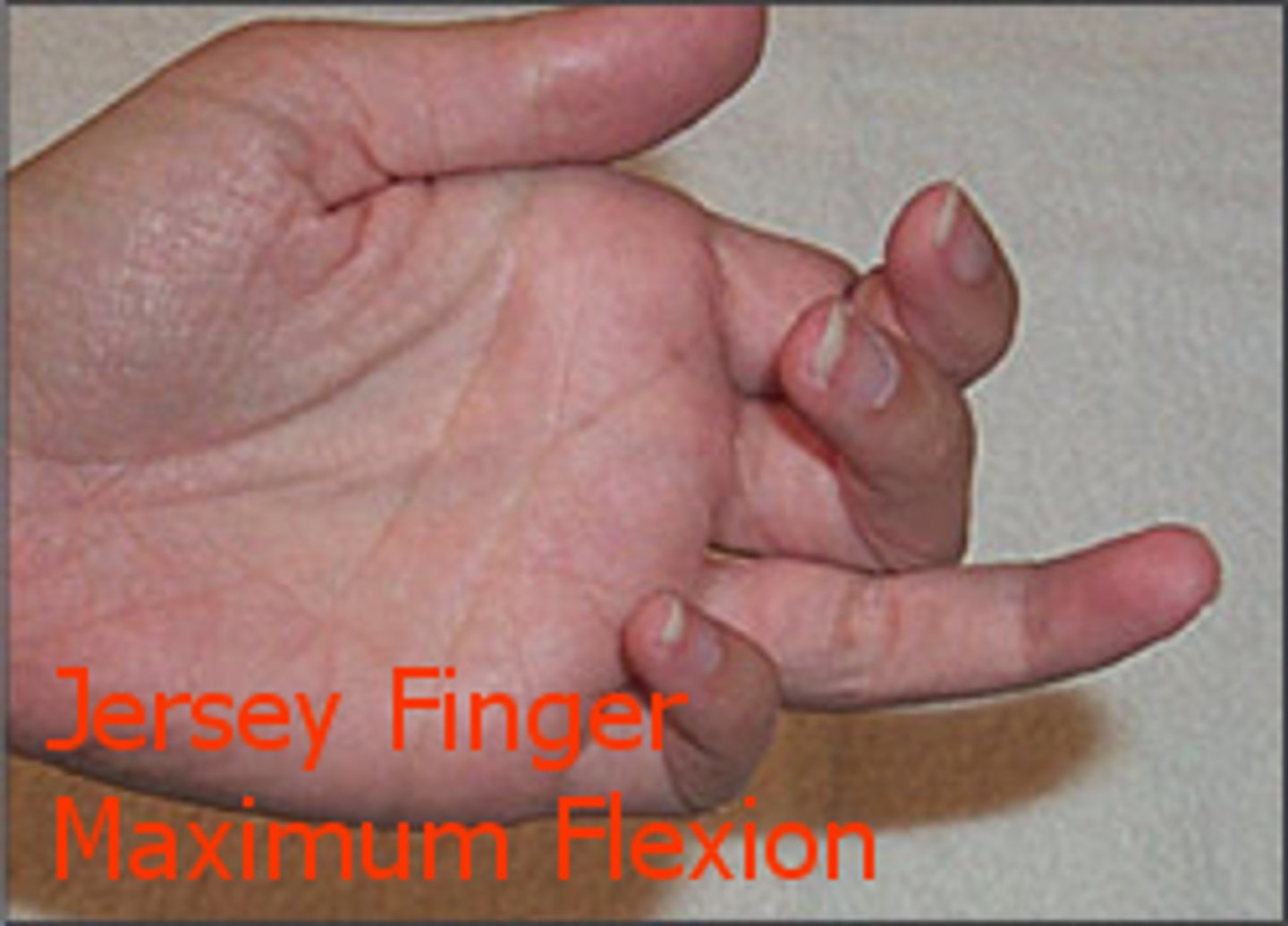 <p>FDP tendon avulsion or rupture that causes the inability to actively flex the DIP joint</p>