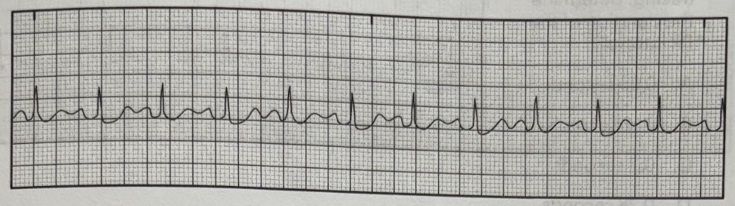 <p>Using the 1500 method, determine the patient’s heart rate from the EKG tracing<br>A. 85/min</p><p>B. 95/min</p><p>C. 105/min</p><p>D. 115/min</p>