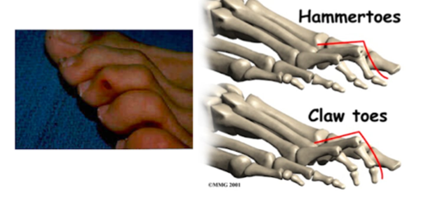 <p>bent toes (usually multiple) in a claw-like fashion</p>