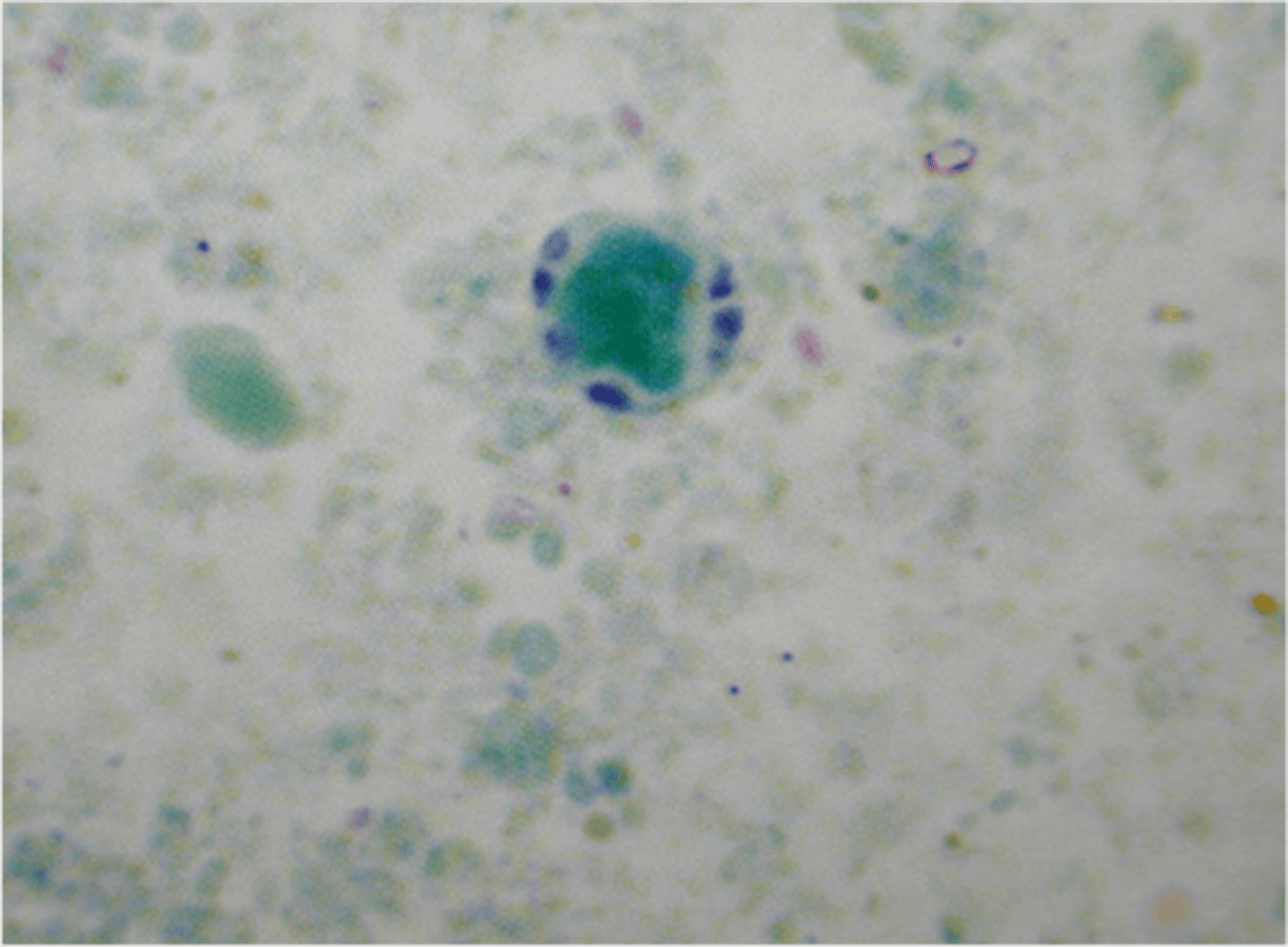 <p>-very common</p><p>-IBS?</p><p>-central vacuole taking up most of the cell and nuclei pushed to outside!</p>