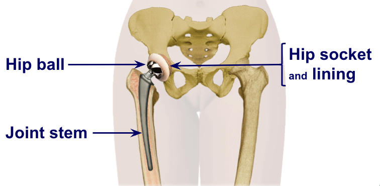 <p>joint stem important bc this depends on the person (tall vs short)</p>