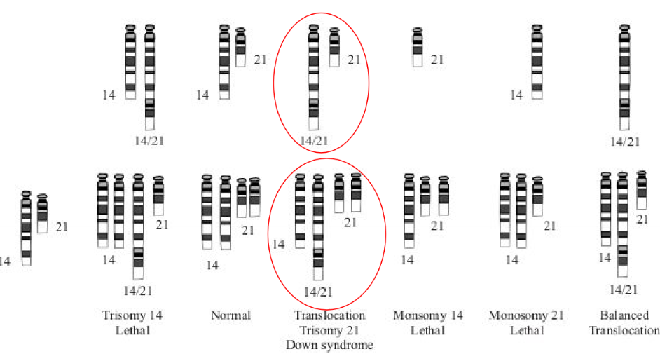 <p>Translocation Down Syndrome (Trisomy 21 Down Syndrome)</p>