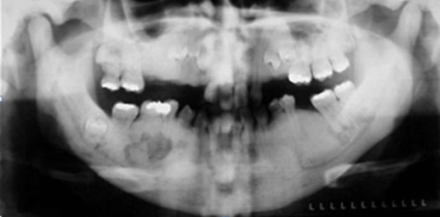 <p>Patient's radiograph presents with a diffuse, symmetric increase in bone density and enlargement of bone (marble bone appearance). Patient experiences neural deficits in the face. What is the diagnosis?</p>