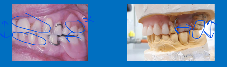 <ul><li><p>The <strong>vertical</strong> dimension can be determined by the natural teeth</p></li><li><p>there are not enough inter-cuspating posteriors to determine the mandibular horizontal position so you use RCP - centric relation&nbsp;</p></li></ul><p></p>