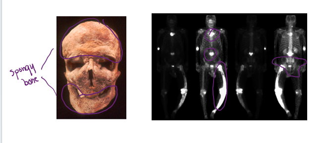 <p><span style="font-family: Wingdings">§</span><span style="font-family: Arial">Excessive bone formation and breakdown: uncontrolled remodeling</span></p><p><span style="font-family: Wingdings">§</span><span style="font-family: Arial">Pagetic bone</span><span>&nbsp; </span>= excessively high ratio of spongy to compact bone is formed</p><p><span>•</span><span style="font-family: Arial">Weaker than normal bone</span></p><p><span style="font-family: Wingdings">§</span><span style="font-family: Arial">Osteoclast activity wanes, but osteoblast activity continues to work</span></p><p><span style="font-family: Wingdings">§</span><span style="font-family: Arial">Often affects the spine, pelvis, femur, and skull</span></p><p><span style="font-family: Wingdings">§</span><span style="font-family: Arial">Unknown cause (possibly viral)</span></p><p><span style="font-family: Wingdings">§</span><span style="font-family: Arial">Treatment includes bisphosphonate drugs and calcitonin</span></p>