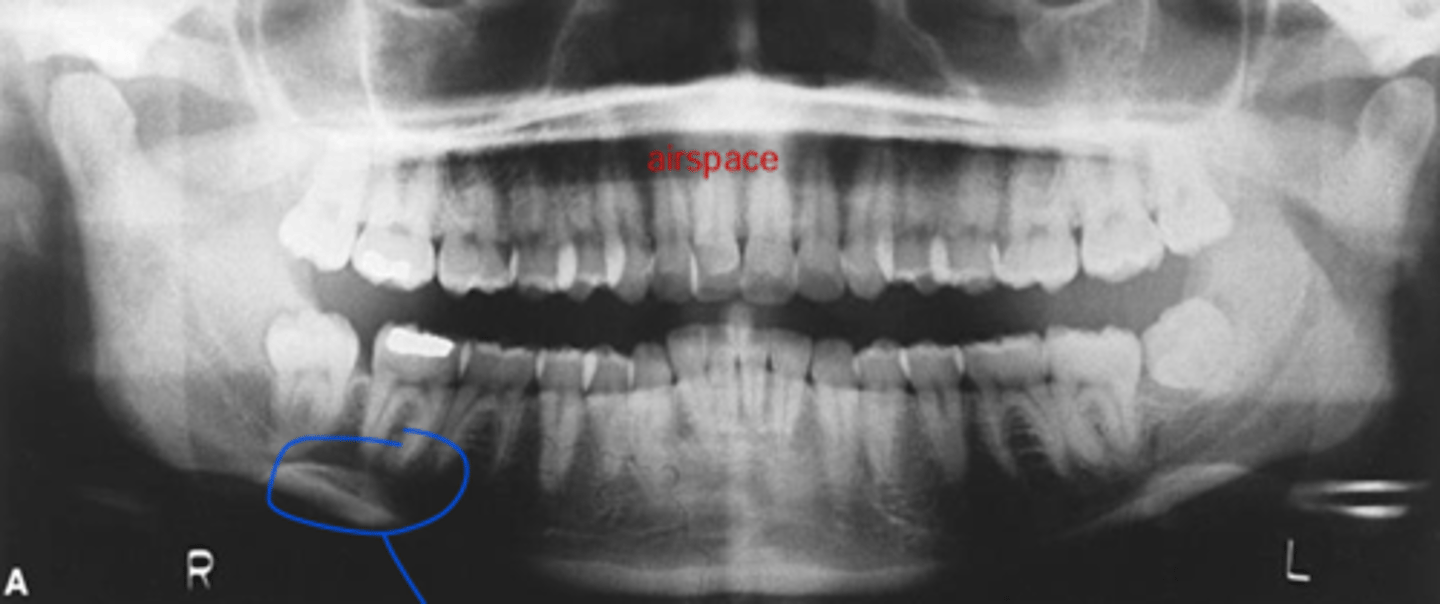 <p>What is the structure circled in blue?</p>
