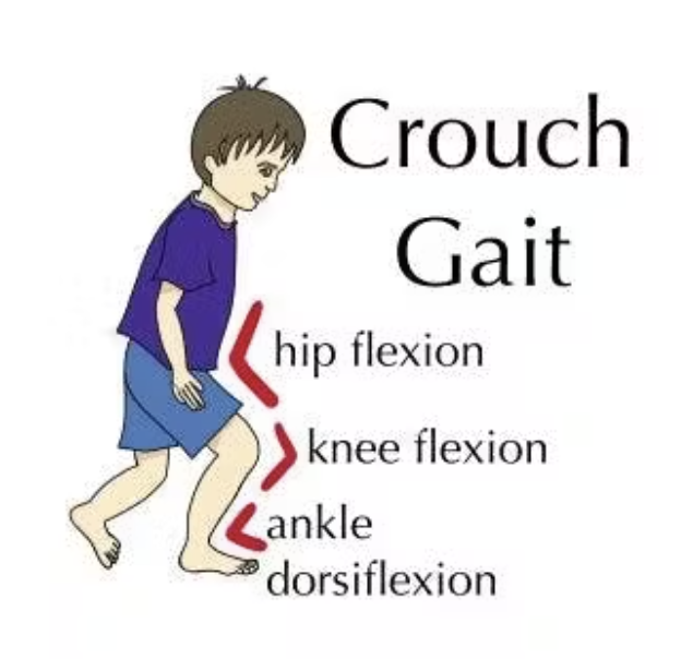 <p><strong>Impairment:</strong> </p><ul><li><p><span style="color: blue;">Knee flexion contracture</span></p></li><li><p><span style="color: blue;">hamstring tightness or spasticity</span><br></p></li></ul><p><strong>Deviation/Compensation:</strong> <span style="color: red;">Crouch gait</span> — knee remains excessively flexed</p><p></p>
