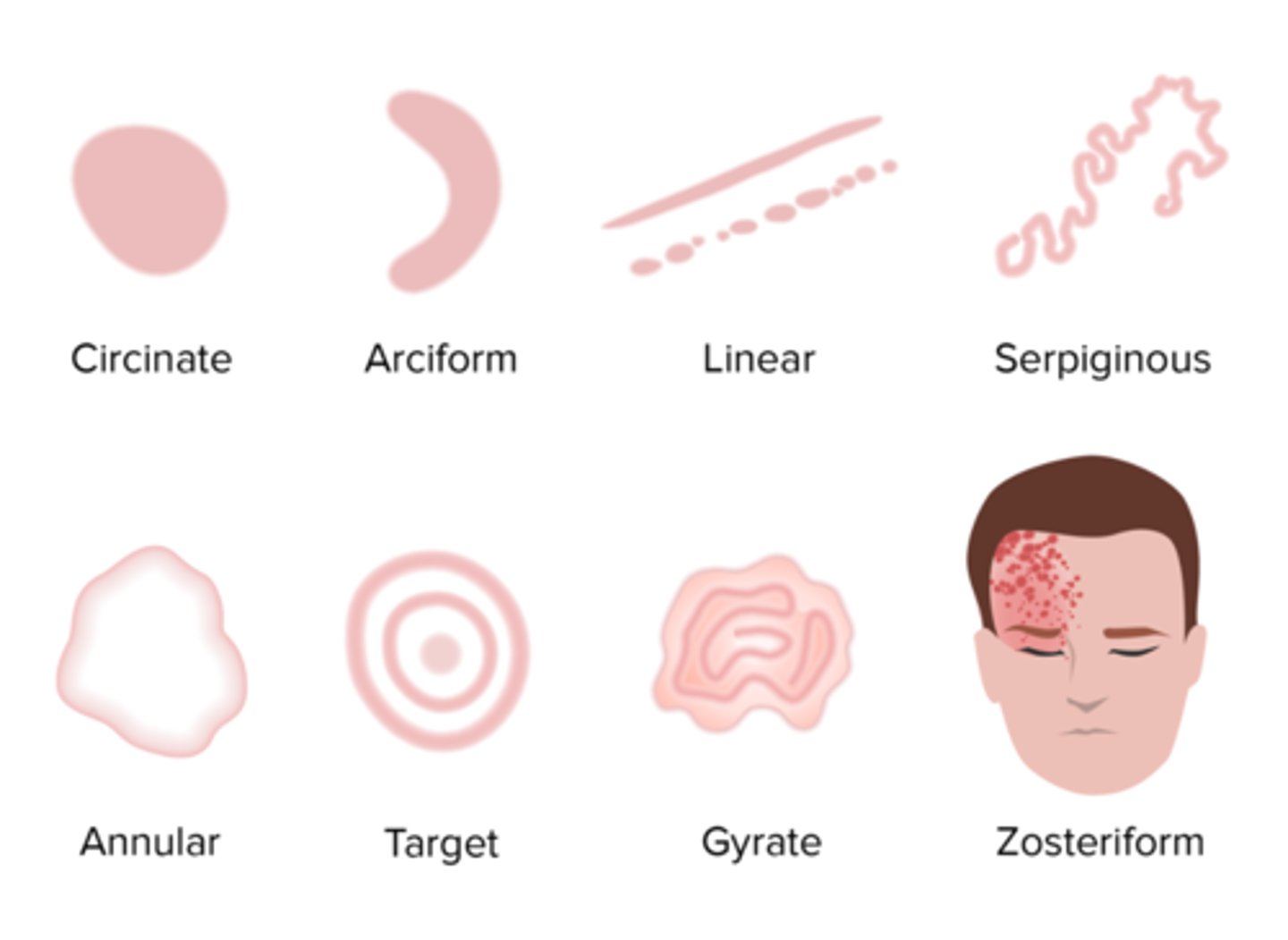 <p>Geographic: resembles the outline of a map</p><p>Reticular: lesions with a "net-like" arrangement</p><p>Umbilicated: skin nodule with a central depression</p><p>Vegetative: the proliferation of papillomatous masses</p><p>Verruca: wart</p>