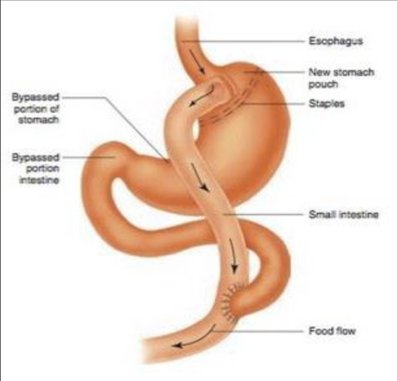 <p>Gastric bypass</p>