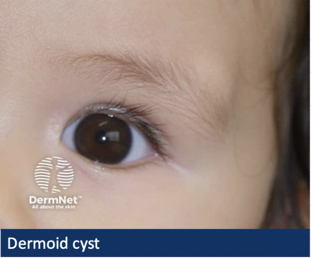 <p>> Superficial</p><ul><li><p><strong>painless slow growing nodule</strong></p></li><li><p>often around the<strong> eyelid/brow</strong></p></li></ul><p></p><p>> Deep</p><ul><li><p><strong>Presents in adolescence</strong> or adulthood</p></li><li><p>Increasingly <strong>protruding eye</strong> , acute inflammation</p></li></ul><p></p>