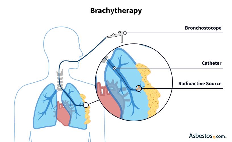 <p></p><p><span style="color: rgb(234, 97, 215);"><strong>Internal radiation </strong>therapy <strong>(Brachytherapy</strong></span>) description and Nursing Care! (6)</p><ul><li><p>Is pt <strong>radioactive</strong>?</p></li></ul><p></p>