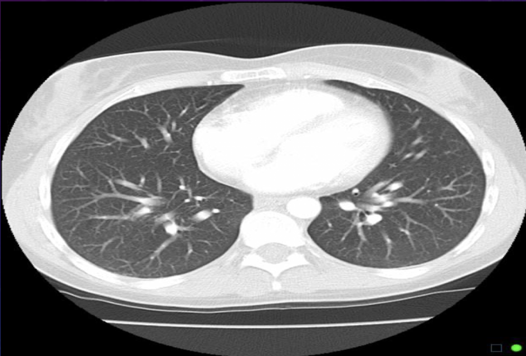 <p>For a lung window for a thorax scan, why do we want a wide WW?</p>