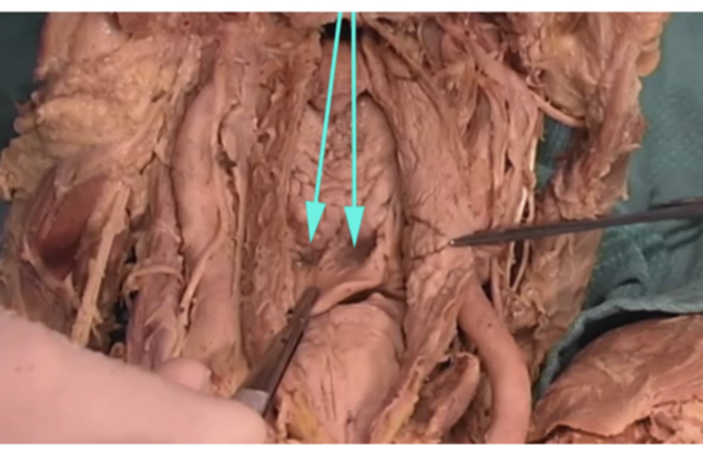 <p>What can get caught in these areas?</p><p>-tongue</p><p>-sharp objects swallowed</p><p>-nasal cavity</p><p>-pectoralis major</p>
