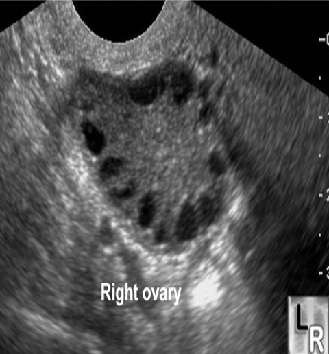 <p>What are the sonographic findings for PCOS?</p>