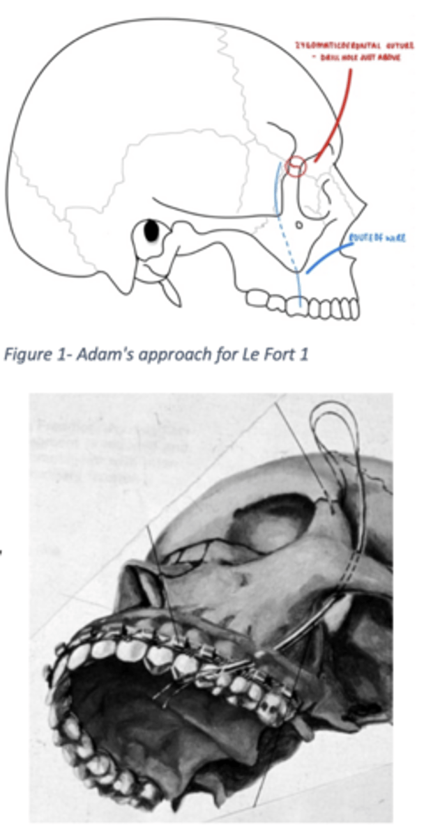 <p>Le Fort 1:</p><p>Zygomaticoalveolar crest</p><p>(because this area remains stable.)</p><p>Le Fort II:</p><p>Infraorbital rim</p><p>because it is above the fracture.</p><p>Le Fort III:</p><p>Supraorbital rim</p><p>because almost the entire midface is detached and only structures above the orbit remain stable.</p>