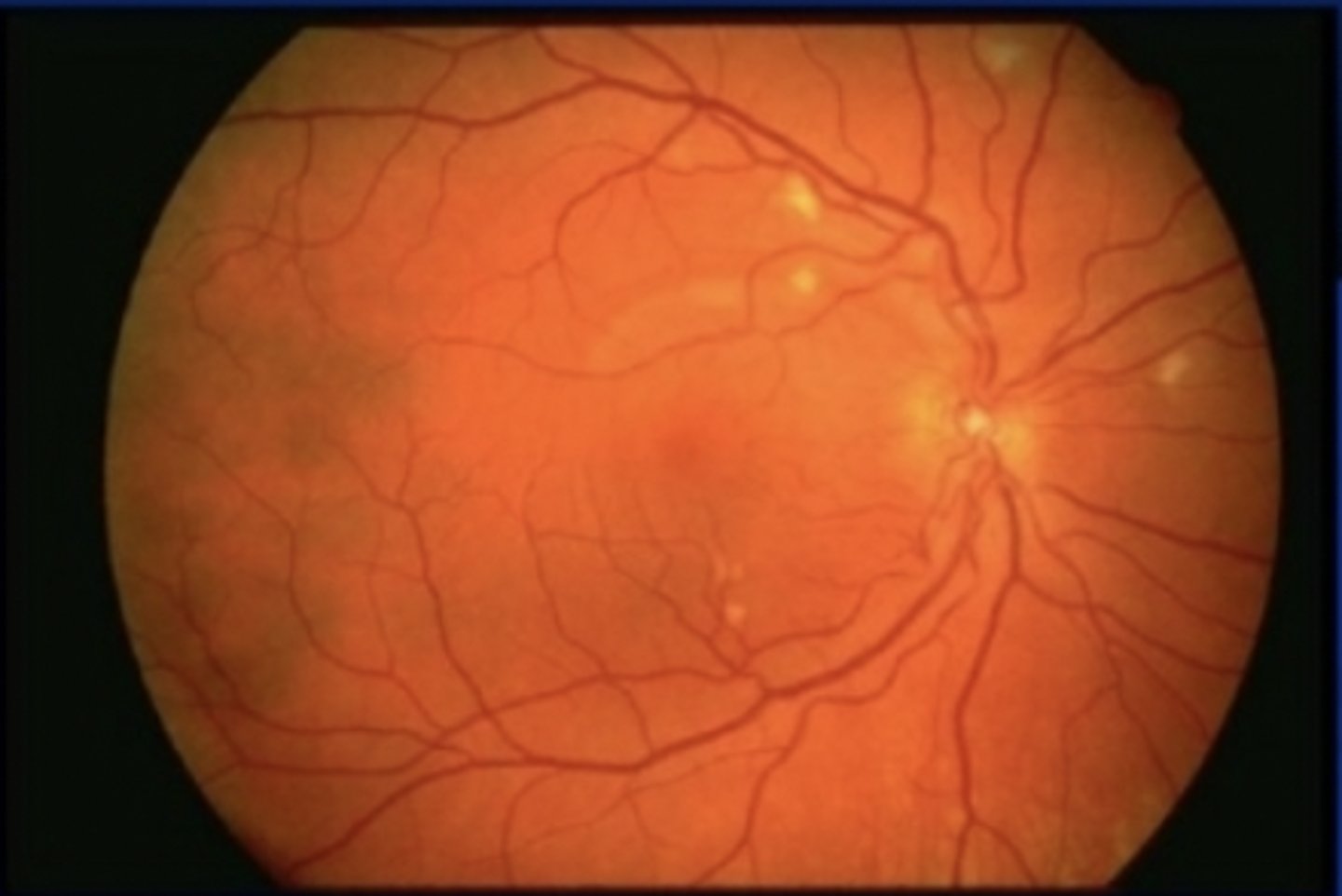 <p><u>Etio</u>: <strong>positive HIV test </strong></p><p><u>S&amp;S</u>: <strong>cotton wool spots</strong></p><p><u>Complications</u>: CMV &amp; blindness</p><p><u>Tx</u>: Urgent consult ophthalmologist &amp; infection control</p>