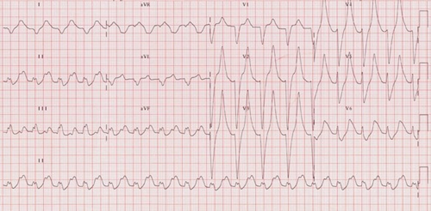 <p>Calcium gluconate—shifts K+ intracellular</p>