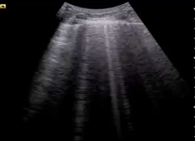 <p>What type of artifact looks like vertical hyperechoic lines?</p>