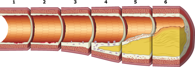 <p>Atherosclerosis plaque development in order</p>