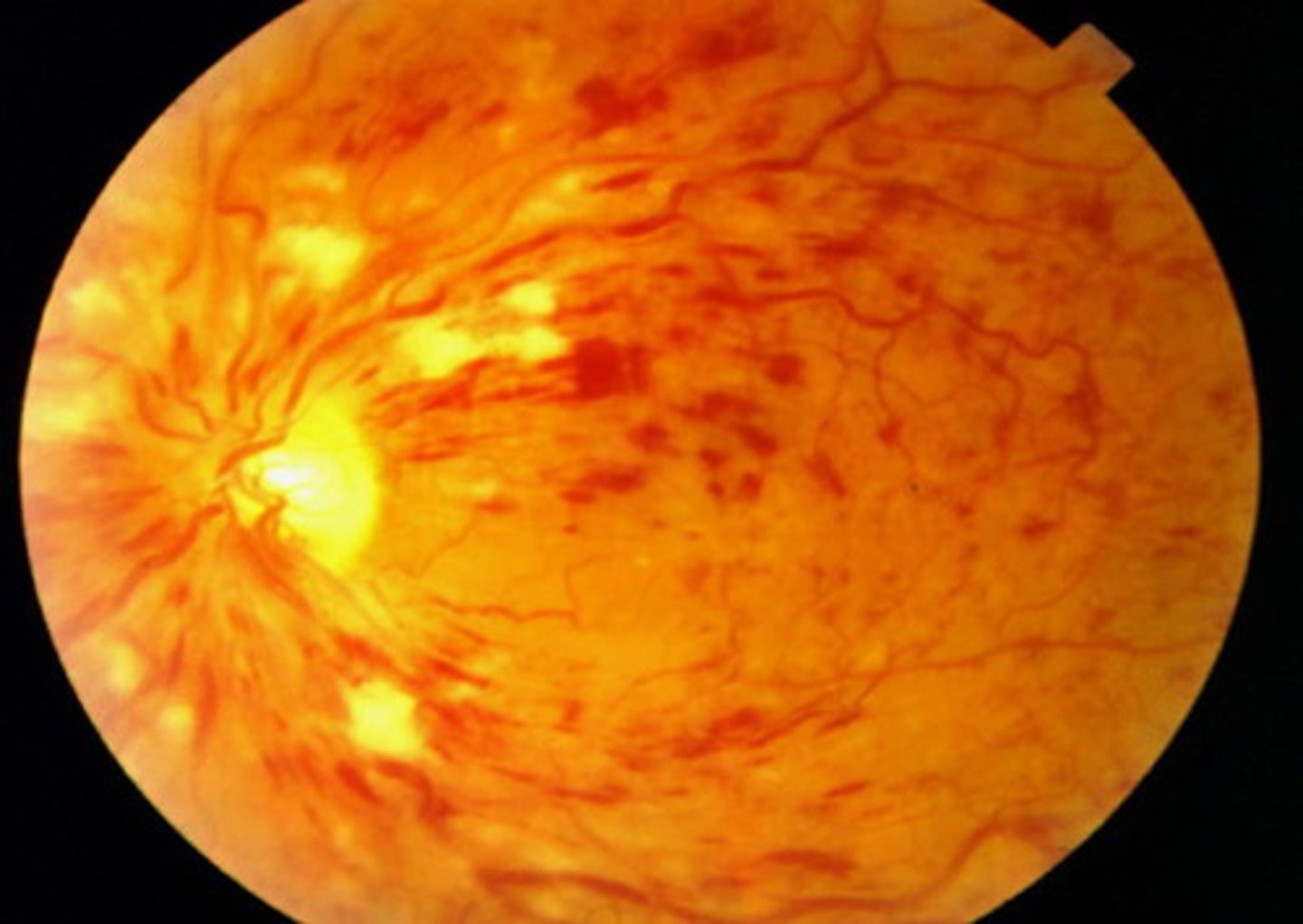 <p>- dilated tortuous veins</p><p>- flame and blot haemorrhage</p><p>- cotton wool spots</p><p>- hard exudates</p><p>- abnormal leakage of fluid from vessels - retinal oedema</p>