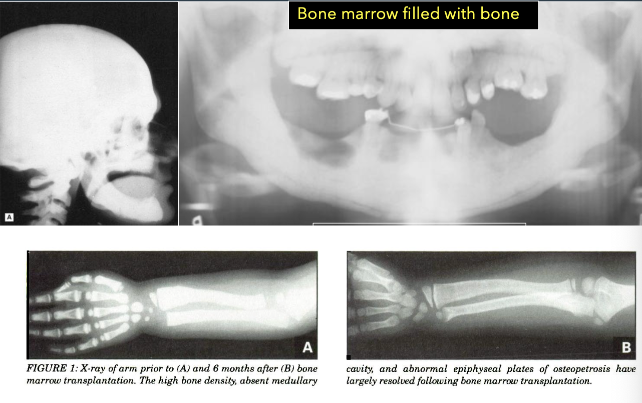 <ul><li><p>Bone marrow transplant</p></li><li><p>Palliative</p></li></ul><p></p>