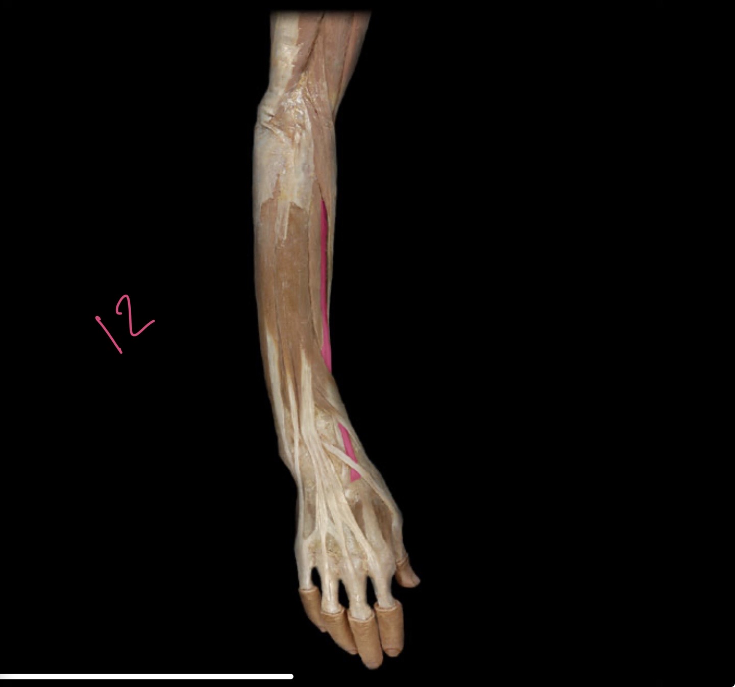 <p>Extensor carpi radialis m</p>
