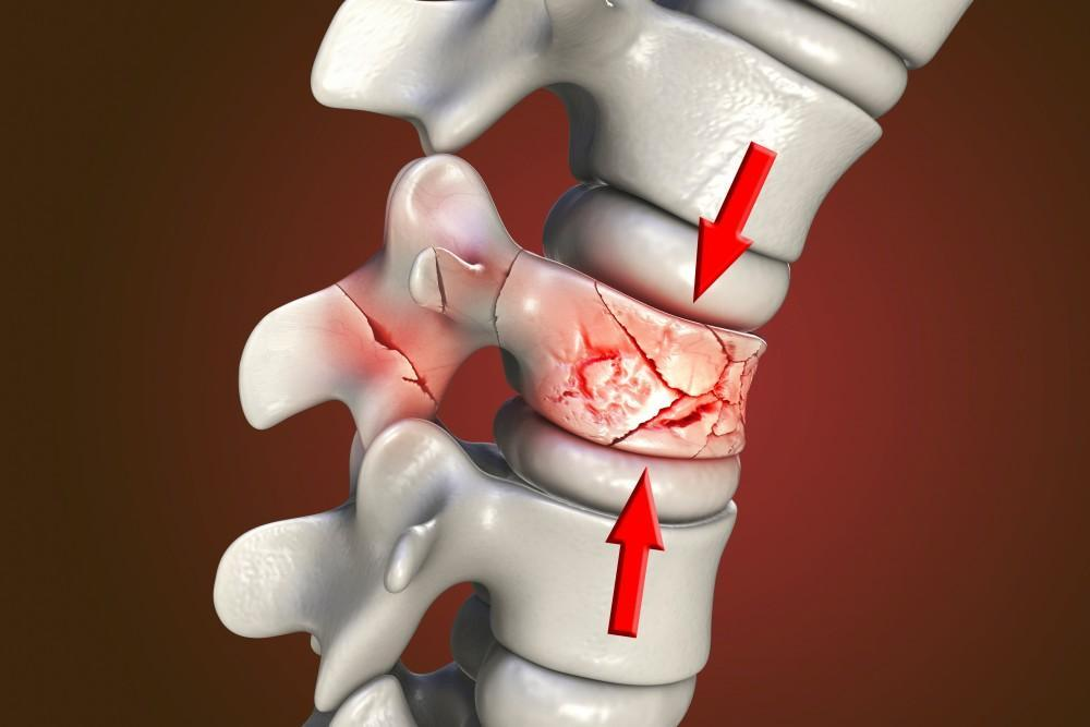<p>the bone is crushed</p>