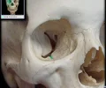 <p>Canal in floor of orbit Continuous posteriorly with infraorbital groove Opens anteriorly through infraorbital foramen Transmits infraorbital nerve, artery, and vein</p>
