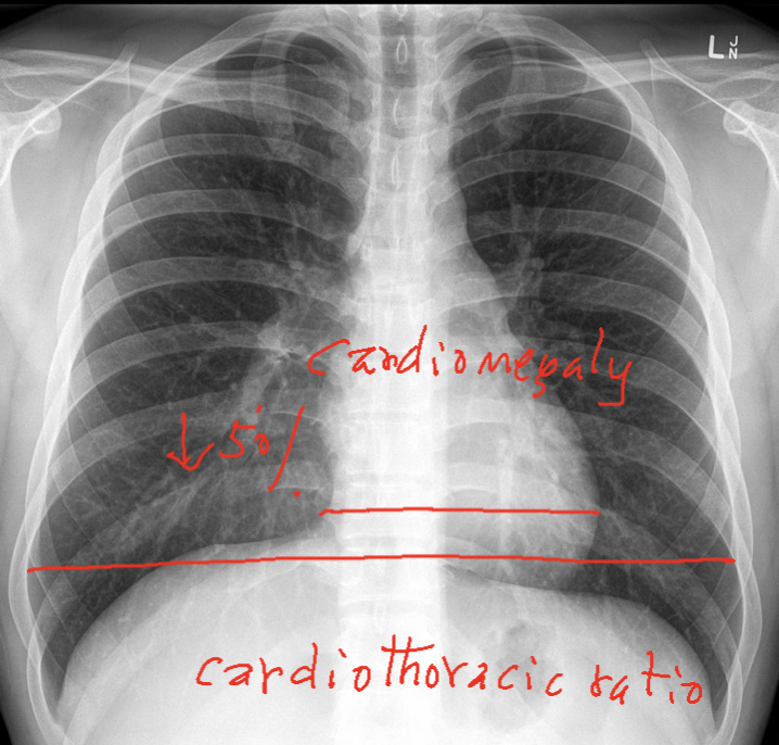 <p>If the transverse diameter of heart is larger than 50% the transverse diameter of the rib cage, the heart is… </p>