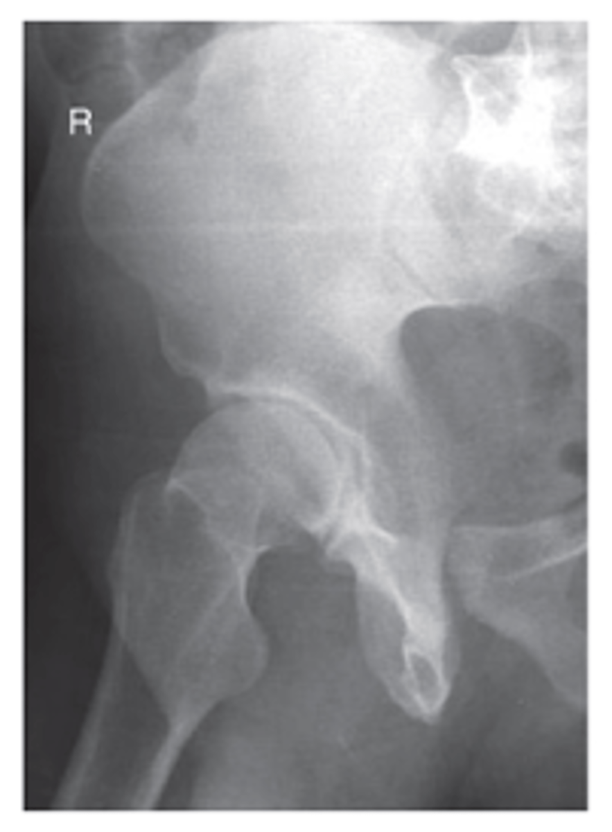<p>- CR 2 inches (5 cm) distal and medial to downside ASIS</p><p>- Anterior rim and posterior ilioischial column demonstrated</p>