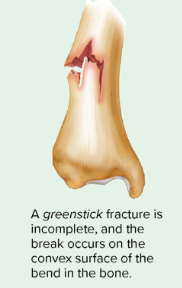 greenstick fracture 