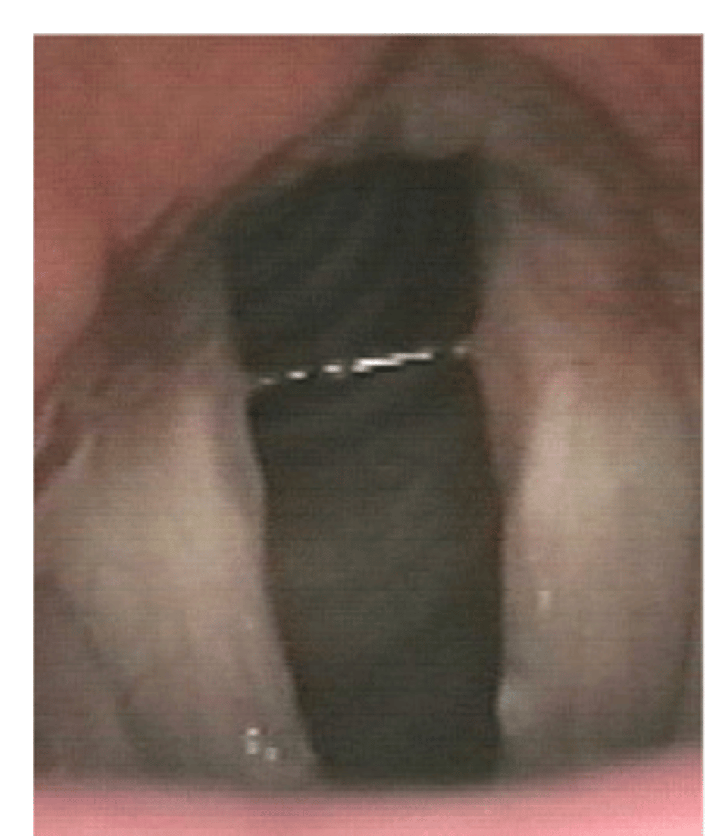 <p>vocal folds wide open, allowing air to pass through freely</p>