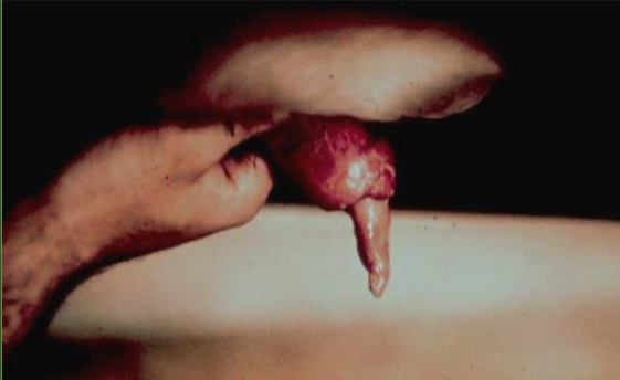 <p><span>Phimosis</span></p><p>Caused by?</p><p>DX?</p><p>Imapct?</p><p>TX/MX?</p>