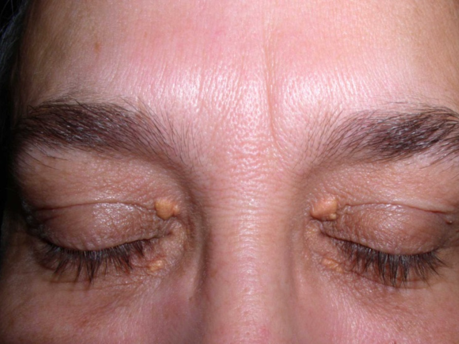 <p>(yellow lesions)</p>