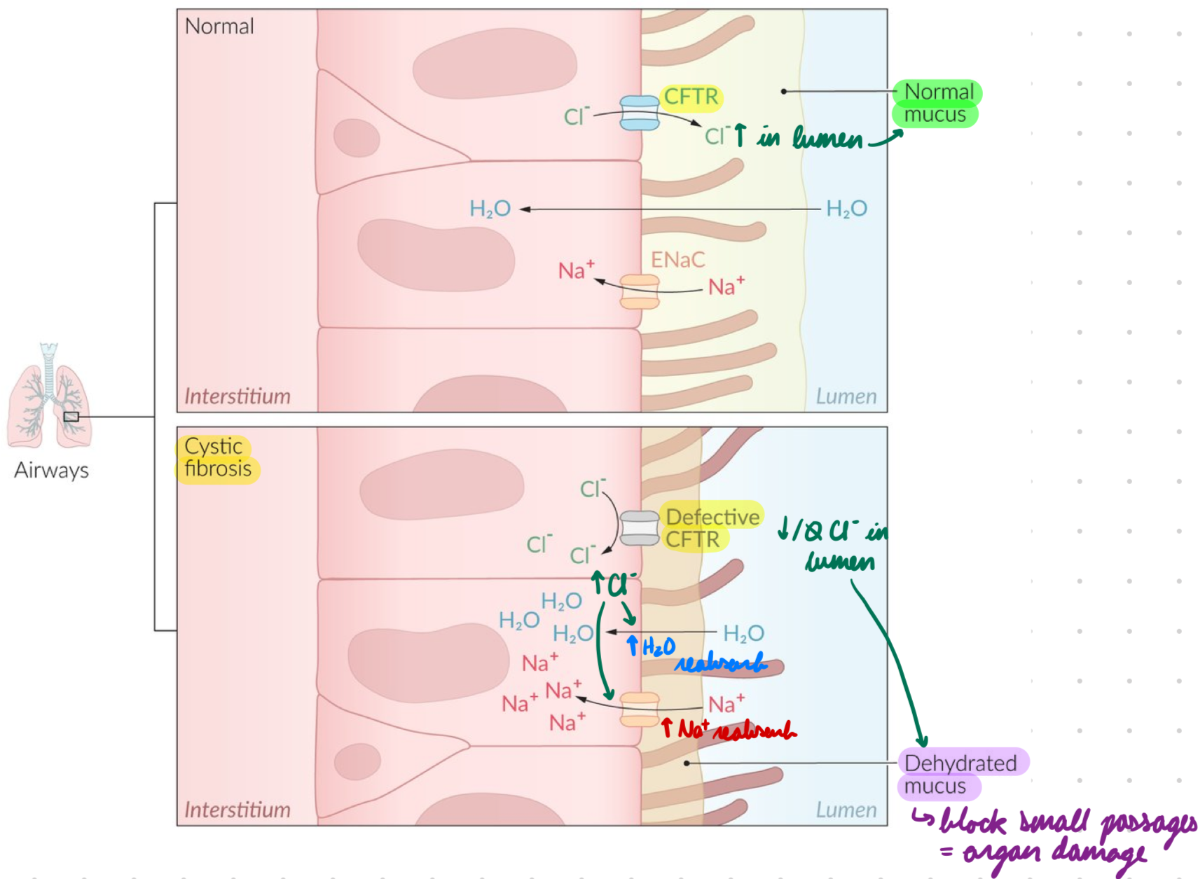 <ol><li><p>CFTR gene mutation = Misfolded CFTR protein</p></li></ol><ul><li><p>Required for ATP-gated Cl- channel</p></li></ul><ol start="2"><li><p>Low/No functioning ATP-gated Cl- channels in epithelial cell membranes</p></li></ol><ul><li><p>Sweat Glands: Low Cl- reabsorption = Low Na+ and water reabsorption = High NaCl in sweat</p></li><li><p>Endocrine Glands: Low Cl- and water secretion into lumen = High Na+ and water reabsorption = Hyperviscous mucus in lumen</p><ul><li><p>Mucus blocks small passages → Organ damage</p><ul><li><p>Lungs</p></li><li><p>Liver</p></li><li><p>Pancreas</p></li><li><p>Intestines</p></li></ul></li><li><p>Increase infection risk</p></li></ul></li></ul><p></p>