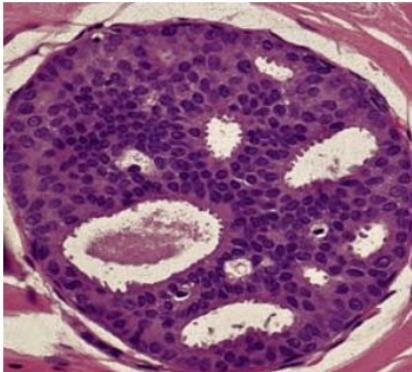 <p>Lesión mamaria preneoplásica que se caracteriza por la proliferación intraductal de células epiteliales con alteración de la polaridad, pleomorfismo, hipercromatismo. Estas células no llenan completamente la luz del ducto y forman puentes con espacios regulares. El diagnostico mas probable es:</p>