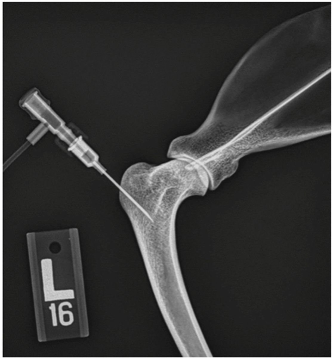 <p>1/11 Route of Administration</p><p>- used in EMERGENCY situations (ex. hemorrhagic shock: low B.P= vein collapsed= can't inject IV= must inject med through 'this' way)</p><p>- uses drill-like needle to inject into bone (proximal end of tibia)</p>