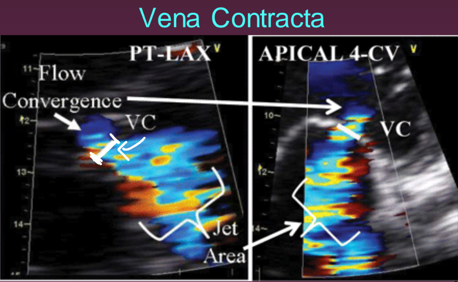 <p>The area of the jet as it leaves the regurgitant orifice and reflects the regurgitant orifice area. (Narrowest area near the mitral annulus).</p>