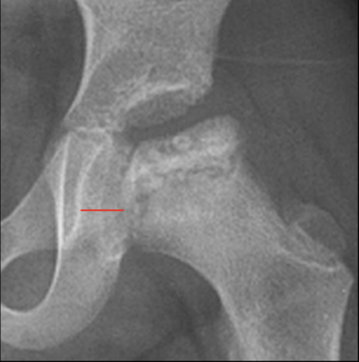 <p>Waldenstrom's sign is usually an indication of _____</p>