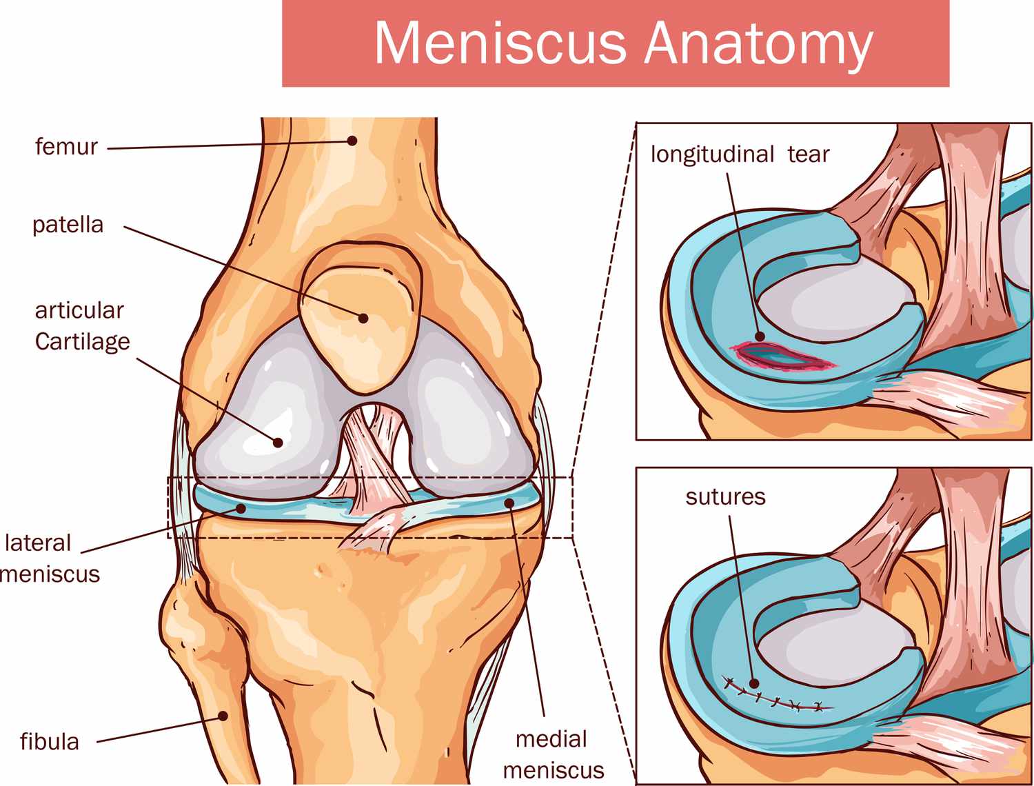 <ul><li><p>semilunar discs between some articulating bones </p></li><li><p>allow bones to fit together tightly </p></li><li><p>provide cushioning for joint </p></li></ul>