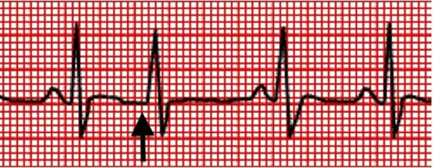 <p>Early junctional beat where the QRS complex is slightly wider than normal &amp; the p wave is absent or inverted</p>