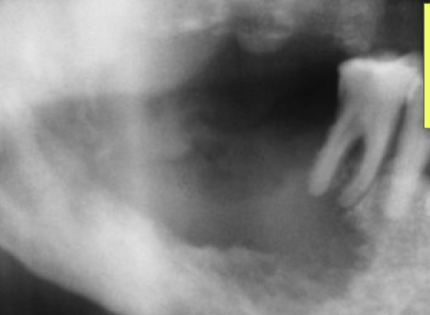 <p>Bone destruction</p><p>Irregular borders</p><p>Moth Eaten</p>