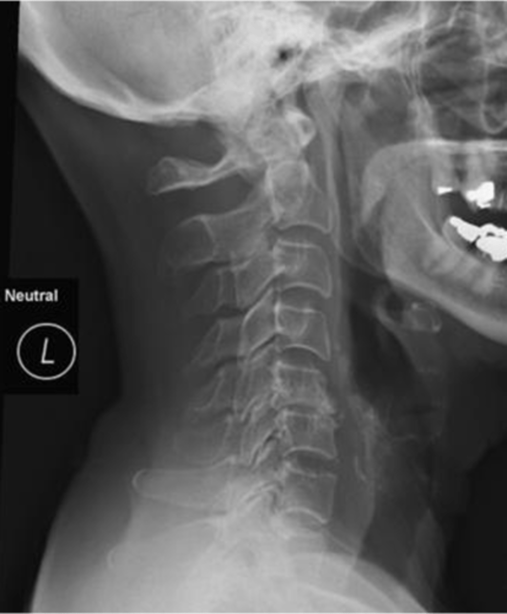 <p>ID type of joint alignment change</p>