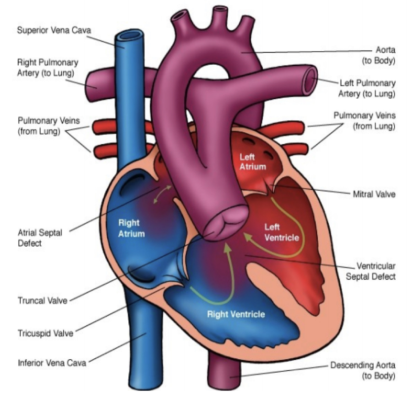 <ul><li><p>results from <strong>inadequate division of the common great vessel during fetal development</strong></p></li><li><p>blood flow pathway</p></li><li><p>a single arterial trunk gives rise to pulmonary, systemic, and coronary circulations</p></li><li><p>usually a single large truncal valve with 2-6 cusps</p></li></ul><p></p>