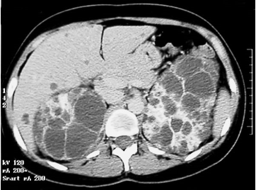 <p><span>A 35-year-old male presents to the office with bilateral abdominal pain and hematuria, progressing during the past 2 months. He states that the pain is located over his flank and is relatively unchanged based on position or time of the day. He has not taken any over-the-counter medications, but heating pads provided no relief. Vital signs reveal a blood pressure of 150/90 mmHg. Physical and osteopathic examination reveals&nbsp;abdominal fullness, with maximal tenderness to palpation at the level of T10 and&nbsp;a discrete somatic dysfunction at that level. Costovertebral angle tenderness is mildly present bilaterally. An abdominal CT scan is obtained as shown in the exhibit. The patient states that his father also had "cysts on his kidneys" but passed away suddenly at 42 years of age. </span></p><p><span>Which of the following is true regarding this person's disease state?</span></p>