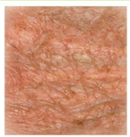 <p>thinning or wasting of the skin, often with a wrinkled or transparent appearance</p>