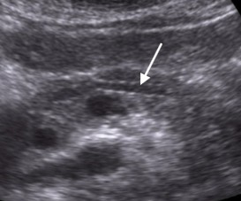 <p>What does the white arrow point to?</p>